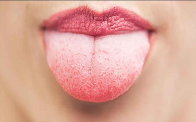 boutton-sur-la-langue