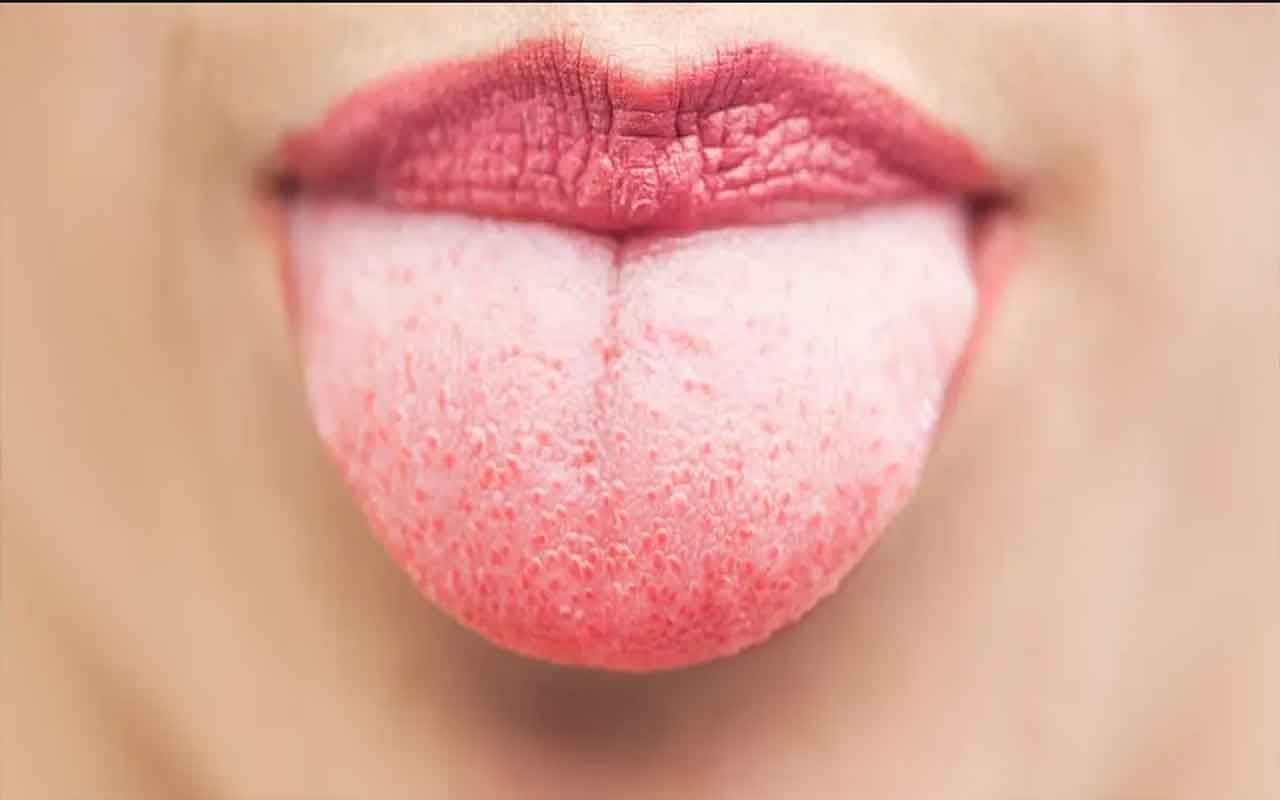 boutton-sur-la-langue