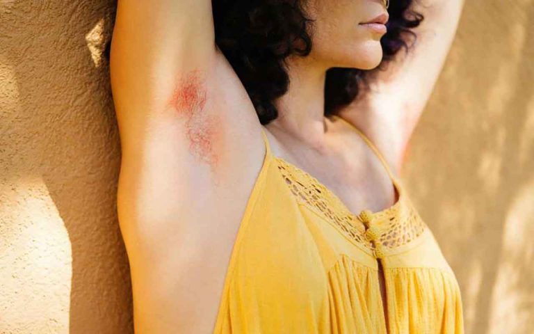 ganglion aisselle soulager