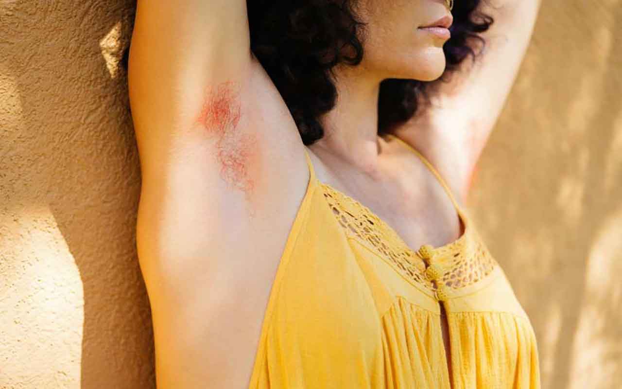 ganglion aisselle soulager